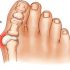 Why a Podiatrist Should Be Your Go-To for Bunion Relief